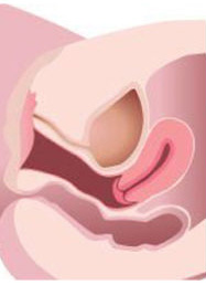 IntimaLase